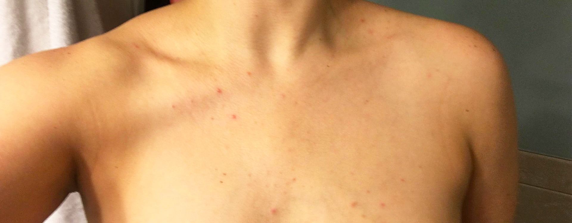 4 choses à savoir pour se débarrasser de son acné sur la poitrine ...