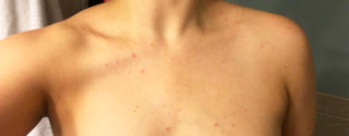 4 choses à savoir pour se débarrasser de son acné sur la poitrine